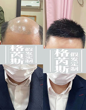 到店測(cè)量頭型，根據(jù)脫發(fā)面積大小進(jìn)行測(cè)量，獲取補(bǔ)發(fā)重要數(shù)據(jù)